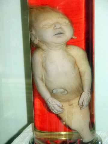 http://upload.wikimedia.org/wikipedia/commons/f/fa/Sirenomelia_preparate.jpg
