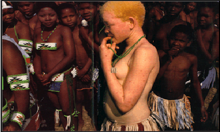 http://www.bio.davidson.edu/Courses/Immunology/Students/Spring2003/Leese/albino.gif