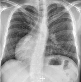 http://www.medgadget.com/archives/img/dextrocardia.jpg